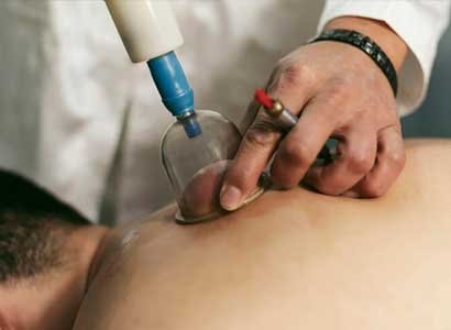 Cupping Therapy Session